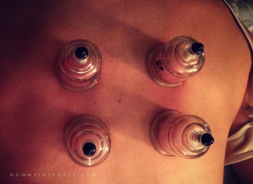 Cupping back